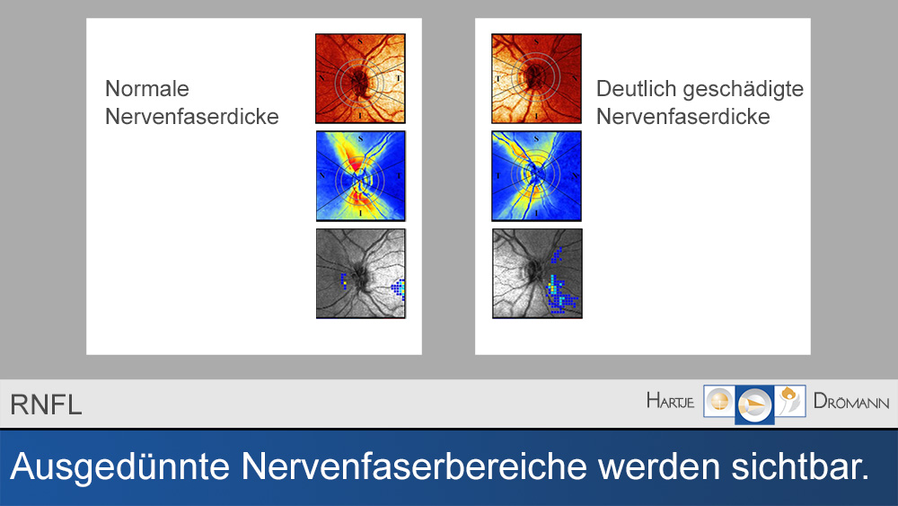 Glaukomfrüherkennung 005